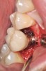 Fig 15. Implant abutment following cement removal.