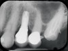 Fig 16. Radiograph depicting closed contact at time of implant insertion.