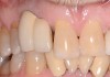Fig 19. In 2016, downward growth of tooth No. 8 could be observed with uneven gingival margins of Nos. 8 and 9.