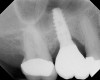 Fig 11. 7-month postoperative radiograph of the restored implant No. 3.