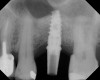 Fig 16. 4-month radiograph with the abutment No. 14 in place. Note the ill-defined old sinus floor.