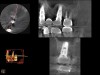 Fig 19. CBCT scan (Kodak 9000D) of implant No. 14 showing homogeneous appearance of the bone.