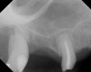 Fig 20. Case 3. Preoperative radiograph showing about 3.5 mm of ridge height.