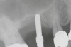 Fig 3. Radiographic marker placed just below the sinus.