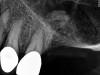 Fig 4. Radiograph showing the sinus membrane being elevated about 8 mm supported by a composite bone graft that is partially radiolucent in the No. 14 position.