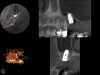 Fig 7. 4-month CBCT scan (Kodak 9000D) of implant No. 14.