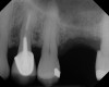 Fig 13. Case 1. Preoperative radiograph showing a ridge height of about 2 mm to 3 mm in the No. 14 position.