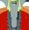 Fig 8. Use of a non-engaging abutment, whether cast to a gold abutment or milled from titanium or zirconia, should be avoided on a locking-taper conical connection (Legend: A. framework; B. non-engaging abutment; C. abutment screw; D. microgap; E. conical connection implant; F. soft tissue; G. bone).