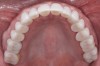 Fig 20. Postoperative occlusal view of maxillary arch with full-contour monolithic high-translucent zirconia restorations on all teeth.