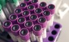 Fig 3. Tray holding blood-filled purple-tipped and green-tipped vacutainer test tubes. Purple tubes test for complete blood count, ESR, hemoglobin A1c, and ammonia, while green tubes also test for ammonia. (This image is licensed under public domain and is a work of the US government. In general, under section 105 of the Copyright Act, such works are not entitled to domestic copyright protection under US law. http://www.freestockphotos.biz/stockphoto/17099)