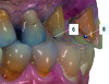 (3.) Digital mock-up of prosthesis replacing missing incisor.