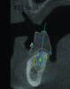 (11) The use of CBCT and digital software for implant treatment planning. The radiographic guide in combination with a 3D CBCT was used to help plan implant position and location.