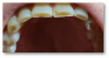 Fig 6. Dental erosion maxillary anterior from soda consumption.