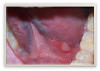 Fig 8. Aphthous-type ulceration.