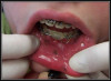 Fig 9. Peutz Jegher’s syndrome
oral pigmentation.