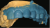 Fig 15. After the wax cooled, the silicone index was removed.