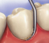 Fig. 1 Mechanical debridement, the traditional method of removing plaque and calculus.