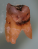 Fig. 6 Practitioners should assume that microscopic biofilm covers the entire surface at a site where persistent inflammation is present. Removal of just the identifiable calcified debris may not be sufficient to return the site to health.