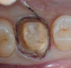 Figure 3: Retraction cord placed for a single-unit crown preparation. Note the 360º visibility of the cord.