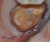Figure 6: Removal of the retraction cord. Be sure to wet the cord first to avoid traumatizing the tissue, then thoroughly air-dry the tooth to prepare for the hydrophobic VPS material.