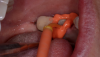 Figure 7: Injecting the light-body impression material.