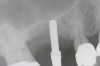 Radiographic marker placed just below the sinus.