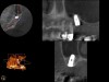 A 4-month CBCT scan (Kodak 9000D) of
implant No. 14.