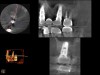 CBCT scan (Kodak 9000D) of implant No. 14 showing homogeneous appearance of the bone.