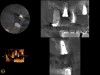 CBCT scan (Kodak 9000D) of No. 3 area, day of placement. Appearance of native bone and bone graft is clearly discernable.