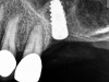 Radiograph of implant N o. 14 and graft in place, day of placement.
