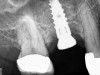 Radiograph of implant N o. 3 and sinus augmentation, day of placement. There is about 2 mm to 3 mm of native bone, and the sinus has been raised about 8 mm to 9 mm.