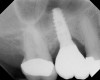 A 7-month postoperative radiograph of the restored implant No. 3.