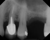 Case 1. Preoperative radiograph showing a ridge height of about 2 mm to 3 mm in the No. 14 position.