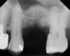 Radiograph of sinus composite bone augmentation in the No. 14 position.