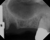 Case 2. Preoperative ridge in the No. 14 position. The height of native bone is about 4 mm to 5 mm.