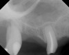Case 3. Preoperative radiograph showing about 3.5 mm of ridge height.