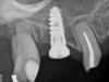 Day of sinus augmentation and implant placement in the No. 3 position. The sinus membrane has been raised about 7 mm to 8 mm.