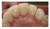Fig 5 and Fig 6. All-ceramic restorations (Fig 5) and opposing dentition wear (Fig 6) produced by all-ceramic feldspathic restorations.