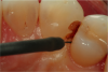 Fig 3. After administration of the marginal anesthesia, the electrosurgery unit was used to make the subgingival margin supragingival.