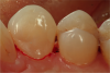 Fig 4 and Fig 5. A matrix now could easily be placed, and the Class III composite filling could be completed. Reestablishment of gingival tissues should occur in about 14 days.