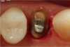 Fig 9. The electrosurgery unit was used to trough around the palatal aspect of the tooth, exposing a small amount of the root surface to the cast core.