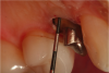 Fig 11. Bone sounding revealed that there was 3 mm from the bone crest to the restorative margin. Thus, no crown lengthening was necessary.