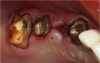 Fig 13. Electrosurgery was used to make it easier to place retraction cord around these posterior teeth, but hemorrhagic tissue remained.