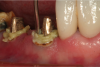 Fig 14. Retraction paste was applied around the teeth.