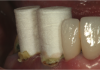 Fig 15. Cotton forms were then placed. These allowed the patient to bite down and compress the retraction paste into the gingival sulcus, helping to stop the bleeding before making the impression.