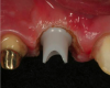 Fig 18. To create an optimal emergence profile for the temporary restoration, the inner sulcus was sculpted using electrosurgery.