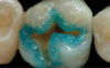 Fig. 2  While selective etching can result in a better enamel etch pattern, the caveat is that it is very difficult to etch only the enamel without spillage onto the dentin.