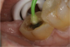 Fig. 3  In this alternative technique to selective etching, “active application” of a universal adhesive to both the enamel and dentin increases the rate of solvent evaporation and facilitates fusion of the monomer into the smear layer.