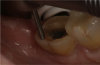 Fig. 5  The margin is re-prepared to expose freshly cut enamel. Controlling the bur is easier than controlling the flow of phosphoric acid.