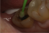 Fig. 6  Acid-etching the preparation to deep etch the enamel and clean the dentin prior to application of universal adhesive.